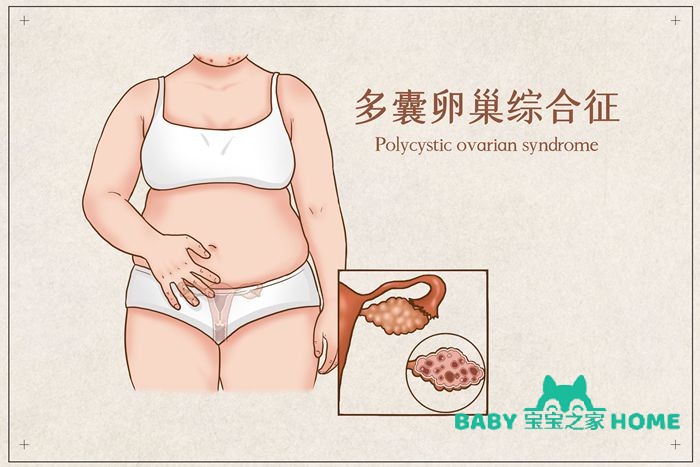多囊卵巢对怀孕的影响