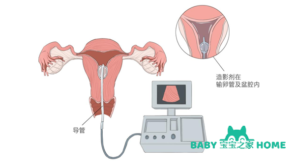 输卵管造影术